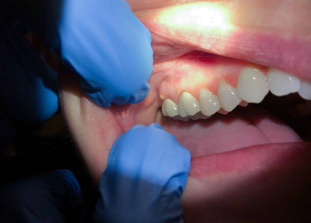 Best Dentist for Tooth Abscess  in Gulf Breeze, FL